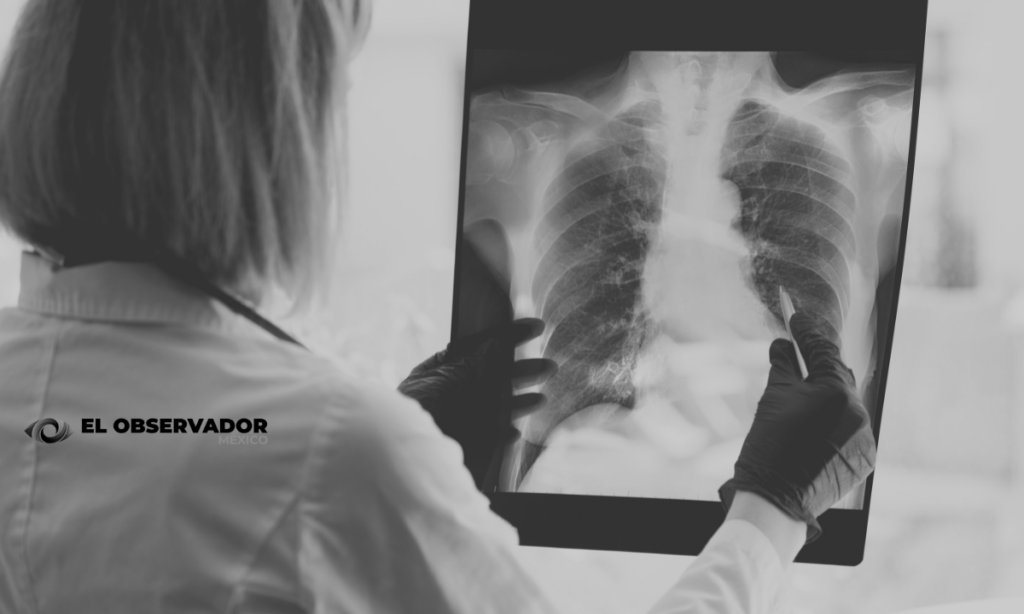 tuberculosis